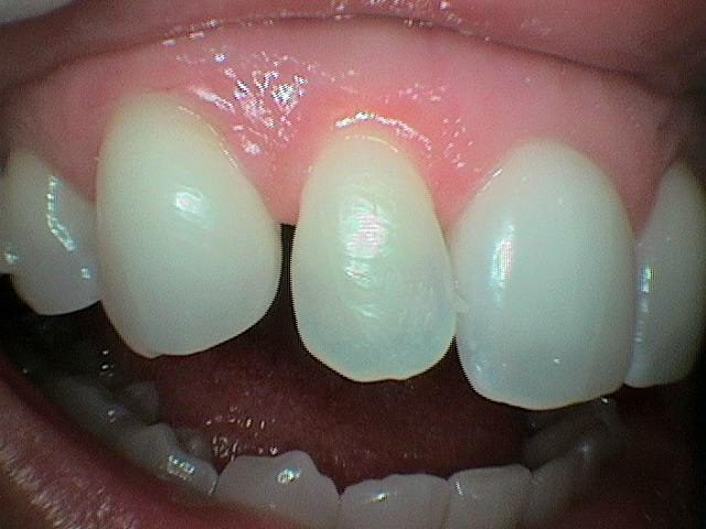 Composite Bonding Before 1