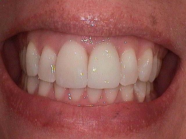 Dental Implant After 1