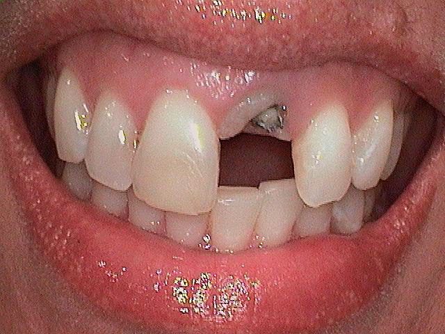 Dental Implant Before 1