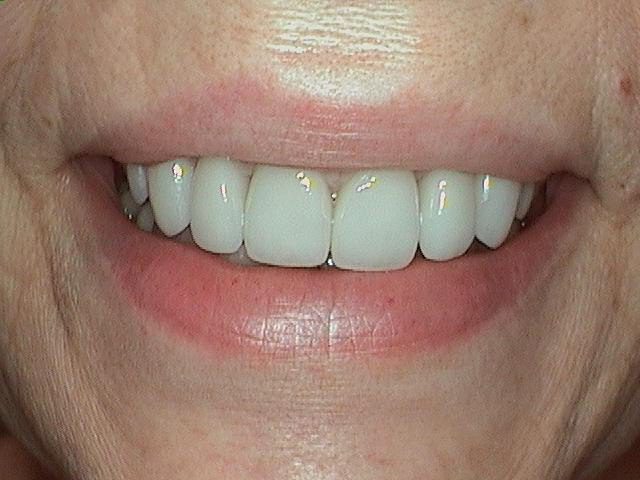 Porcelain Veneers After 1