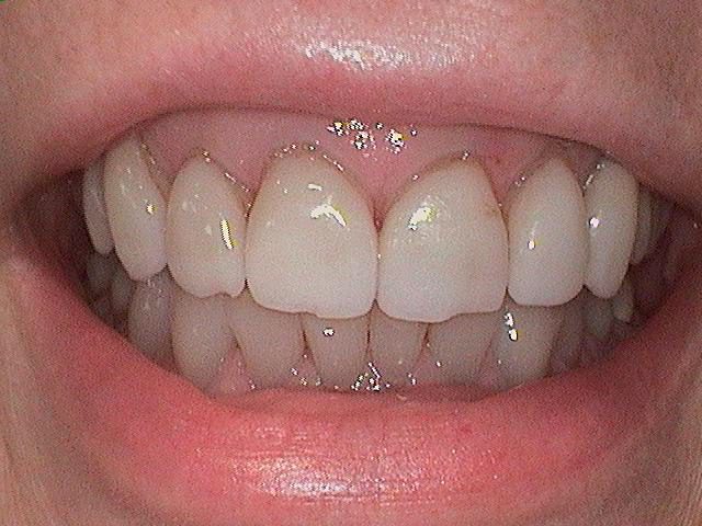 Porcelain Veneers Before 1